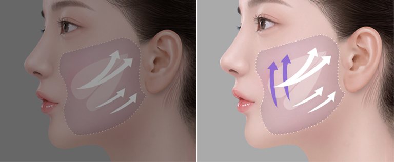 딥플레인(왼쪽)과 듀얼플레인(오른쪽) 리프팅 방향 비교 — 여성 옆얼굴 위 화살표