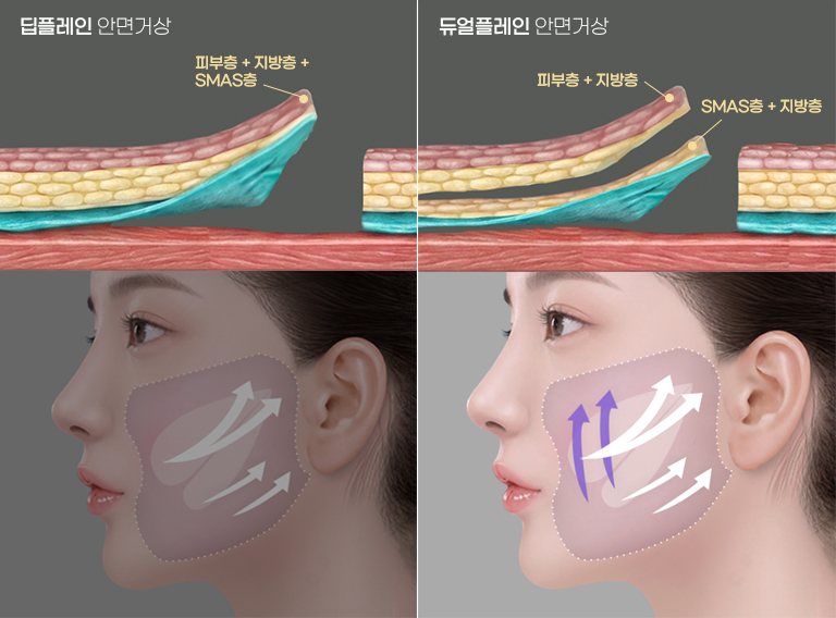 딥플레인 안면거상과 듀얼플레인 안면거상 비교 도식(조직층 박리 단면 + 리프팅 방향)