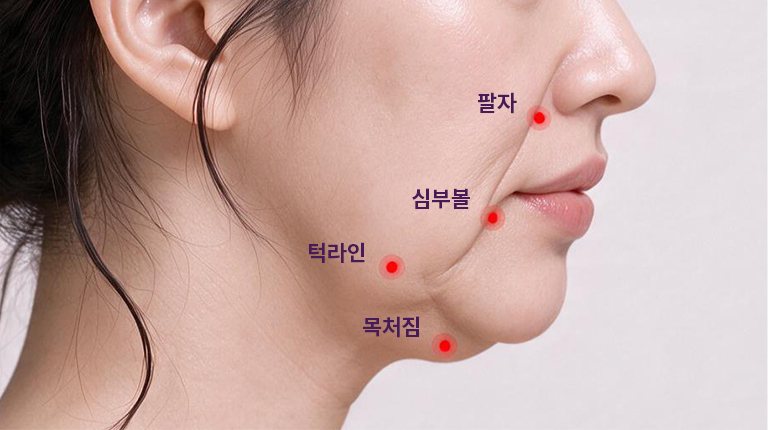 여성 옆얼굴 아래쪽 개선 부위 표시 — 팔자·심부볼·턱라인·목처짐