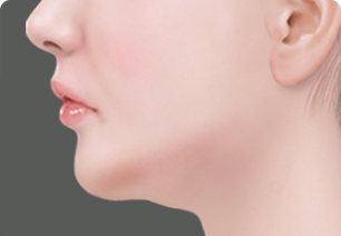 수술과정 1 — 처진 턱·목선의 여성 옆얼굴 일러스트