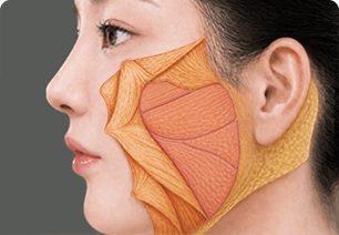수술과정 2 — 피부를 젖혀 드러난 SMAS·근육층 해부 일러스트