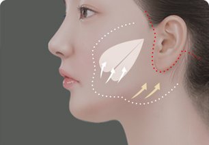 수술과정 3 — 볼 위 박리 구역과 위쪽 리프팅 화살표, 귀 앞뒤 절개선
